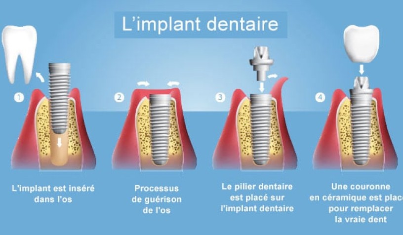 Implant unitaire